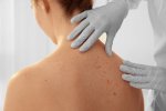 Úc thử nghiệm phương pháp điều trị ung thư da mới