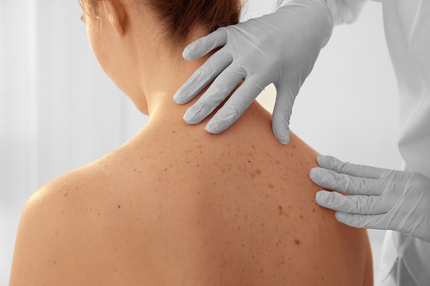 Úc thử nghiệm phương pháp điều trị ung thư da mới